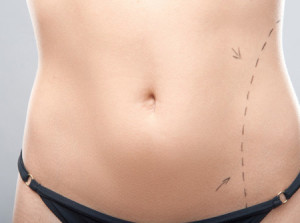Liposuction-Without-Anesthesia