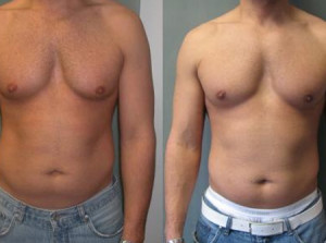 Male-Breast-Reduction